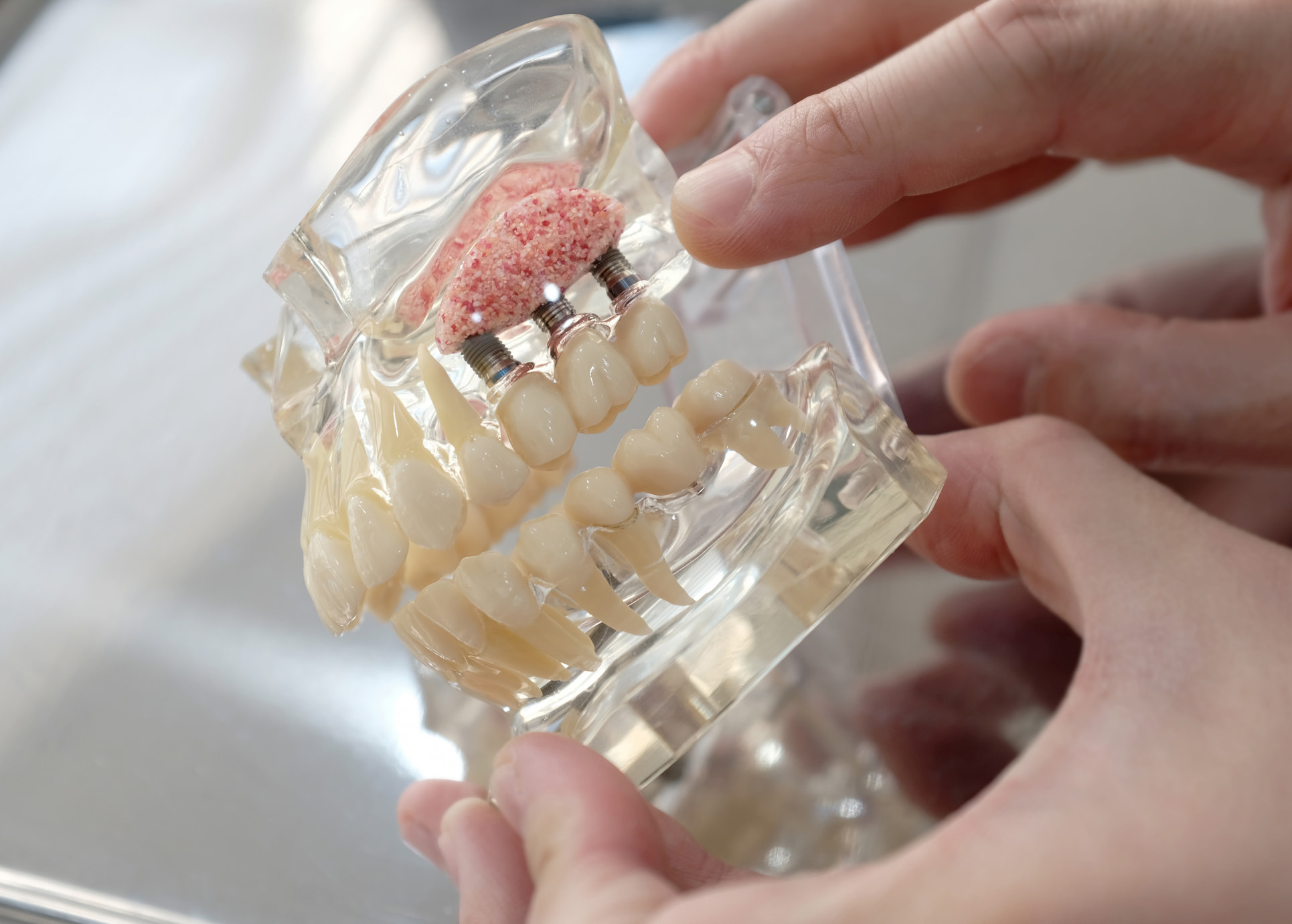 Bone grafting and sinus lift procedures for strong dental implant foundation