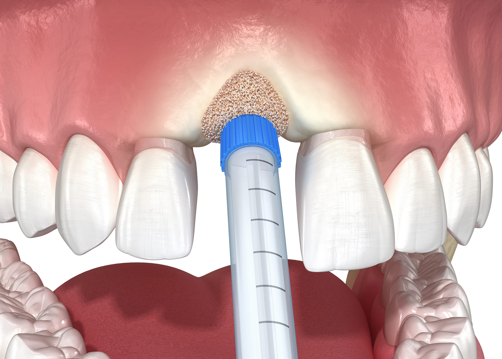 Importance of jawbone health and bone grafts for dental implants
