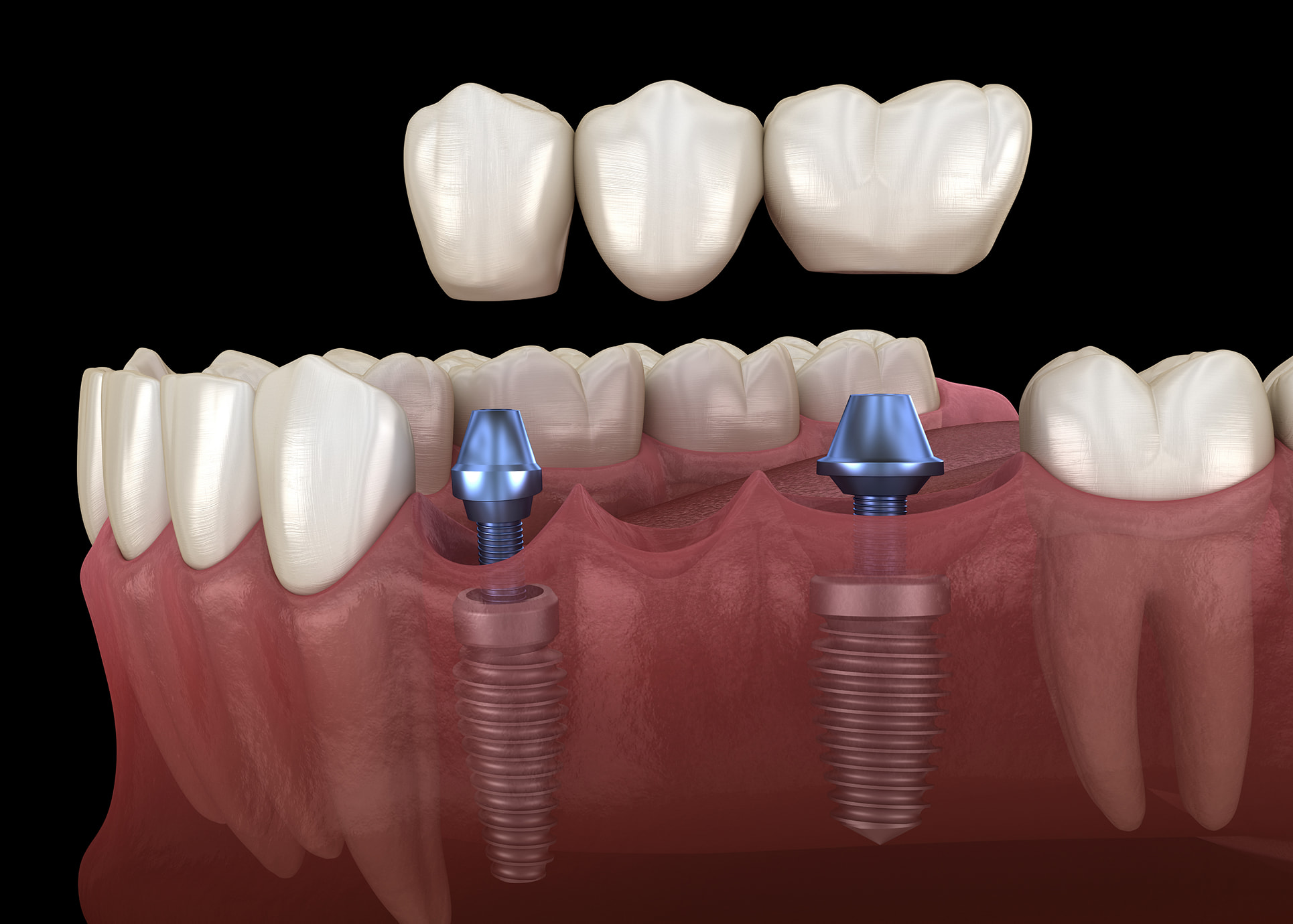 Implant-supported bridge for multiple missing teeth