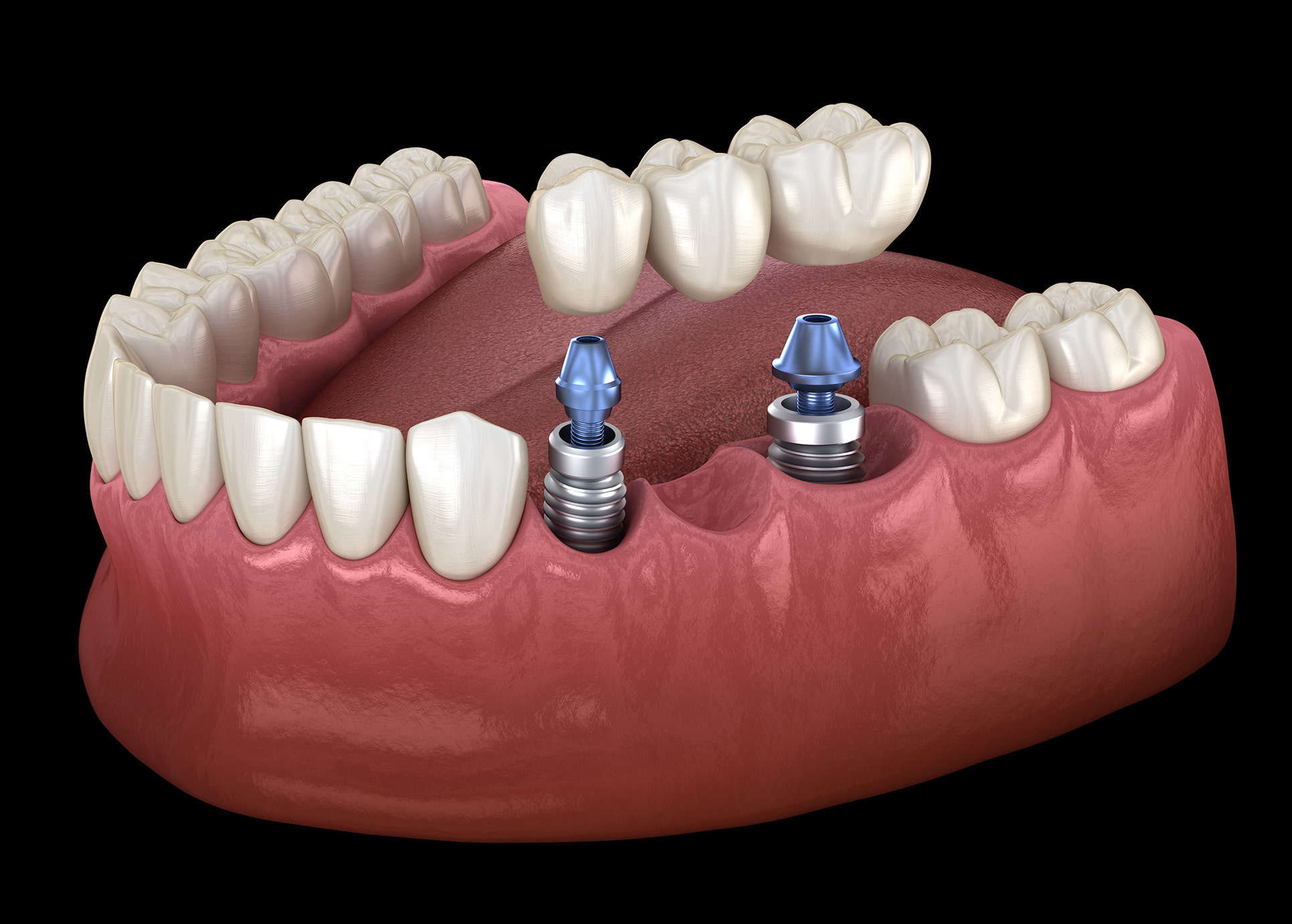 Comfortable and supportive care for implant-supported bridges at Coastal Family Dentistry