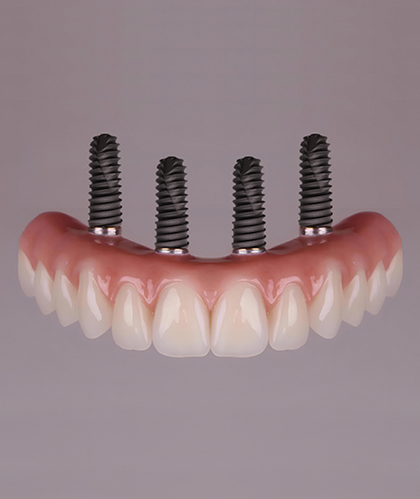 All-on-4® / Full Arch Implants